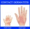 Illustration of Contact Dermatitis