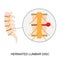 Illustration demonstration of human herniated lumbar disc