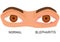 Illustration of eyes with barley. eye diseases. eyelid inflammation. blepharitis. flat vector.