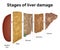 Illustration of the gradual damage of the liver