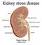 Illustration of Kidney stone disease