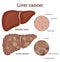 Illustration of the liver cancer