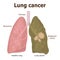 Illustration of lung cancer