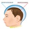 Illustration of a newborn baby with microcephaly disease