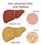 Illustration of non-alcoholic fatty liver disease