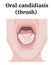 Illustration of Oral candidiasis