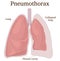 Illustration of Pneumothorax