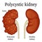 Illustration of polycystic kidney