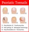 Illustration of Psoriatic toenails