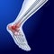 An illustration of a running ankle bone showing red dots representing a joint injury