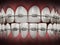 Illustration showing dental braces on straight teeth. 3D illustration