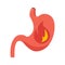 Illustration of stomach burning sensation