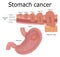 Illustration of stomach cancer