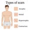 Illustration of the types of scars