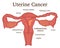 Illustration of uterine cancer