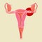 Illustration of uterus with ectopic pregnancy. gynecology