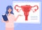 Illustration of the uterus and endometriosis. Doctor explains the results of a gynecological examination. Womens