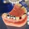 The image of the model of the human jaw and dentures.