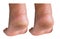 Image before and after treatment of dry heels cracks skin dehydrated skin on heels of female feet.