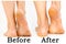 Image before and after treatment of dry heels cracks skin dehydrated sole skin