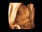 Image Ultrasound 3D, 4D of baby in mother womb