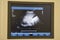 Image on an ultrasound scanner