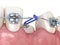 Impacted Cuspid and elastic for correction. Medically accurate dental 3D illustration