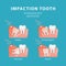 Impaction tooth. Dentistry stomatology vector