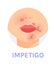 Impetigo. Skin Infection. Red Spots near the Mouth and Nose. Part of a Woman Face. Female Lips Nose and Neck. Color Cartoon style