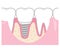 Implant treated teeth