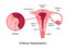 Implantation. stage of pregnancy when embryo adheres to the wall of the uterus. Parts of uterus are marked with lines