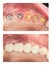 Before and after - implants and crowns