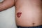 Infantile Hemangioma red birthmark on the baby`s belly