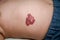 Infantile Hemangioma red birthmark on the baby`s belly