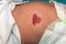 Infantile Hemangioma red birthmark on the baby`s belly