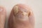 Infected Big Toe