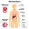 Infectious mononucleosis