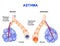 Inflamation of the bronchus causing asthma