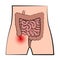 Inflamed Appendix Appendicitis Digestive System