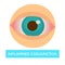 Inflamed conjunctiva conjuntivitis sore eye medicine and health