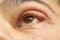 Inflamed eye with infected stye, upper eyelid, ophthalmic medicine