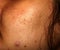 Inflamed skin of the face in pimples and acne. Keloid scars from acne