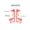 Inflammated sinus with excess mucus and obstrusted sinus openings