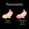 Inflammation of the pancreas. Pancreatitis. The