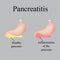 Inflammation of the pancreas. Pancreatitis. Vector illustration on a gray background