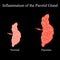 Inflammation of the parotid gland.The structure of the parotid salivary gland. Vector illustration on isolated