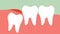 Inflammation of wisdom tooth angular or mesial impaction