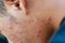 Inflammatory acne