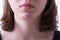 Inflammatory acne on the chin of a teen girl