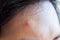 Inflammatory acne with red spot on face closeup